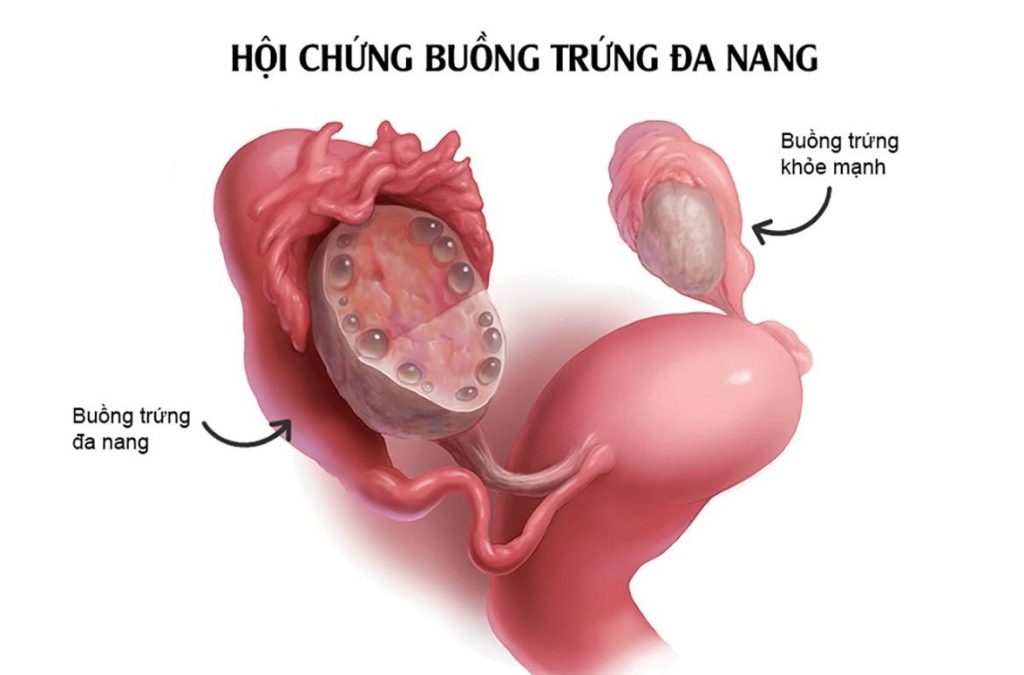 Béo phì gây hội chứng đa nang buồng trứng dẫn đến rối loạn kinh nguyệt